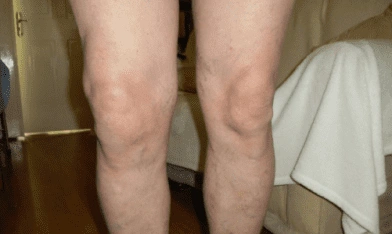 Oštar bol u kolenima pri savijanju