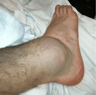 Crvenilo i oticanje zglobova